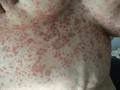 VARIOUS or of UNKNOWN ETIOLOGY DISEASES - Pityriasis rosea