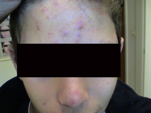 DISEASES OF THE SEBACEOUS GLANDS - Acne vulgaris