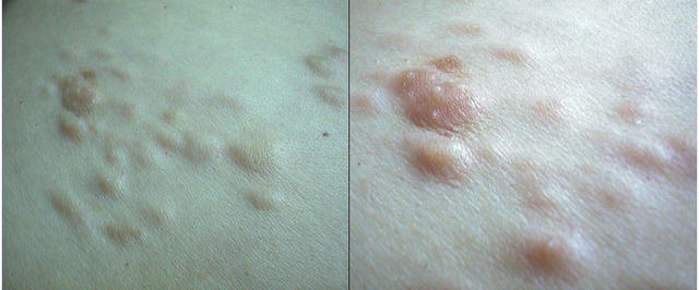 SOFT TISSUE TUMORS - Leiomyomas SOFT TISSUE TUMORS - Leiomyomas