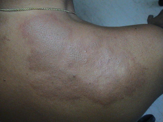 PARASITOSES, BITES - Jelly-fish Dermatitis