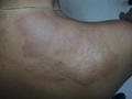 PARASITOSES, BITES - Jelly-fish Dermatitis