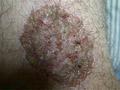SUPERFICIAL FUNGAL INFECTIONS - Tinea infection from Tr. verrucosum