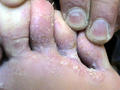 SUPERFICIAL FUNGAL INFECTIONS - Tinea pedis