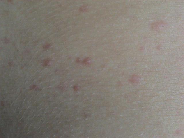 URTICARIA - Cholinergic urticaria URTICARIA - Cholinergic urticaria