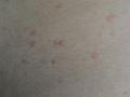 URTICARIA - Cholinergic urticaria