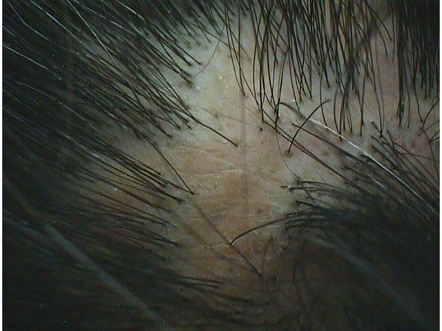 HAIR DISEASES - Alopecia cicatricial