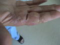 DERMATITIS - EKZEMA - Eczema hyperkeratotic with clefts