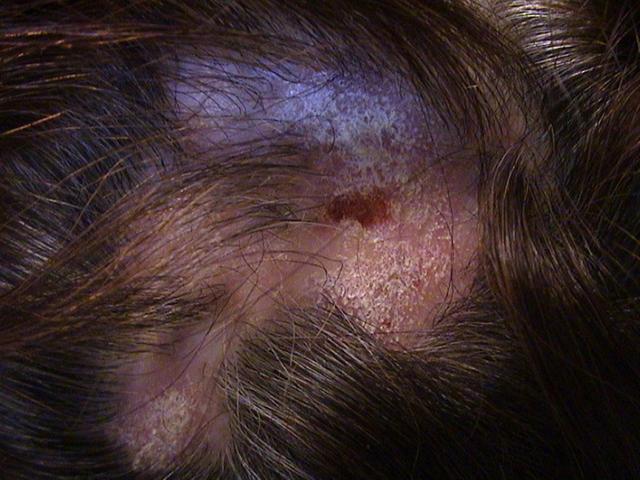 CONNECTIVE TISSUE DISORDERS - Discoid lupus erythematosus
