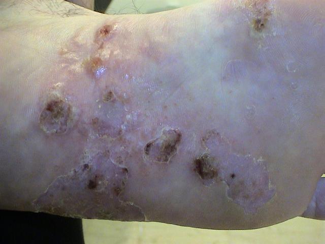 DERMATITIS - EKZEMA - Dyshidrotic eczema DERMATITIS - EKZEMA - Dyshidrotic eczema