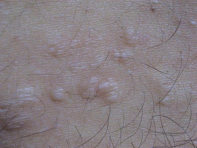 GENODERMATOSES - Tuberous sclerosis complex (Bourneville's disease), adenomata seborrheic