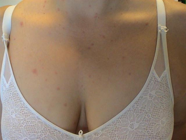 VIRAL INFECTIONS - SmallPox VIRAL INFECTIONS - SmallPox