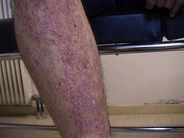 DERMATITIS - EKZEMA - Neurodermatitis