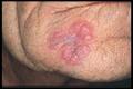 TUBERCULOSIS - Lupus tuberous