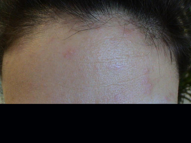 VIRAL INFECTIONS - SmallPox VIRAL INFECTIONS - SmallPox