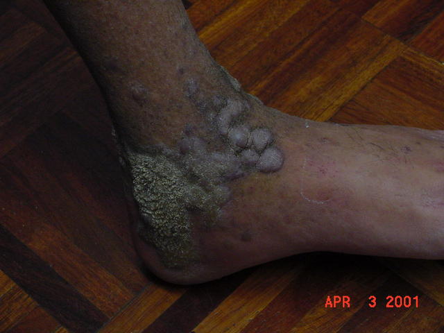 SKIN LESIONS IN HIV-AIDS PATIENTS - HIV Kaposi