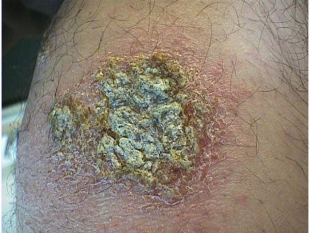 DERMATITIS - EKZEMA - Infected nummular eczema DERMATITIS - EKZEMA - Infected nummular eczema