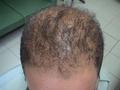 HAIR DISEASES - Androgenetic alopecia