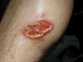 PARASITOSES, BITES - Cutaneous leishmaniasis