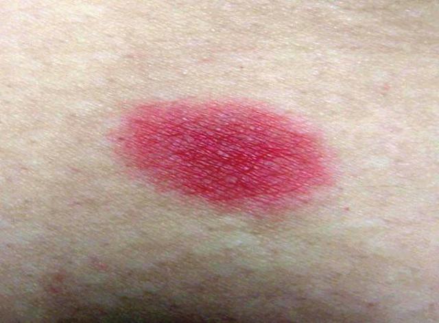 DRUG ERUPTIONS - Fluconazole - induced fixed drug eruption DRUG ERUPTIONS - Fluconazole - induced fixed drug eruption