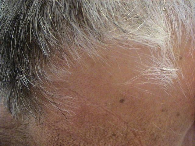 HAIR DISEASES - Alopecia Areata HAIR DISEASES - Alopecia Areata
