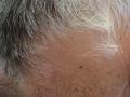 HAIR DISEASES - Alopecia Areata