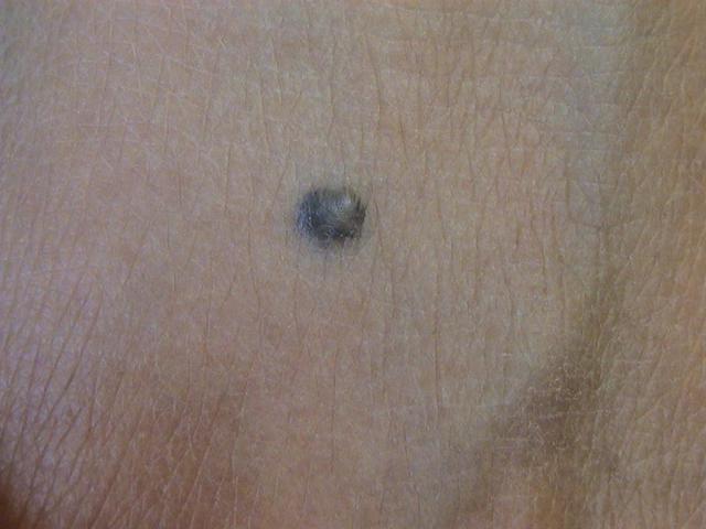BENIGN SKIN LESIONS, NEVI, CYSTS - Blue Naevus BENIGN SKIN LESIONS, NEVI, CYSTS - Blue Naevus