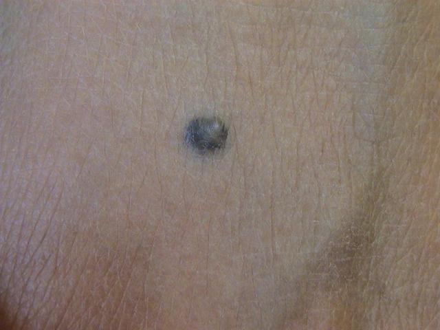 BENIGN SKIN LESIONS, NEVI, CYSTS - Blue Naevus