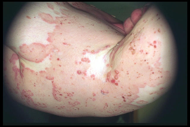 BULLOUS DISEASES - Bullous pemphigoid