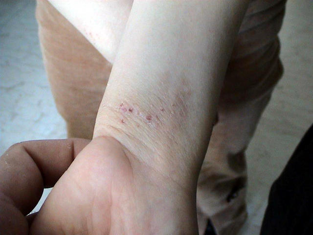 DERMATITIS - EKZEMA - Atopic dermatitis DERMATITIS - EKZEMA - Atopic dermatitis
