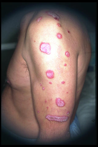 CONNECTIVE TISSUE DISORDERS - Discoid lupus erythematosus CONNECTIVE TISSUE DISORDERS - Discoid lupus erythematosus