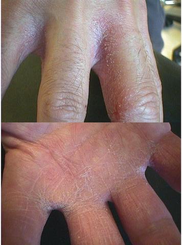 SUPERFICIAL FUNGAL INFECTIONS - Tinea mannum SUPERFICIAL FUNGAL INFECTIONS - Tinea mannum
