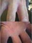 SUPERFICIAL FUNGAL INFECTIONS - Tinea mannum