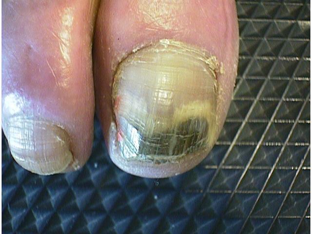 NAIL DISEASES - Onychomycosis