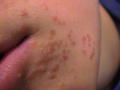 VIRAL INFECTIONS - Warts