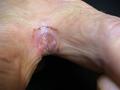 SUPERFICIAL FUNGAL INFECTIONS - Candidiasis