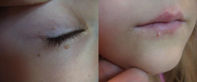 VIRAL INFECTIONS - Warts VIRAL INFECTIONS - Warts