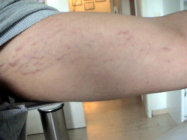 CONNECTIVE TISSUE DISORDERS - Striae CONNECTIVE TISSUE DISORDERS - Striae