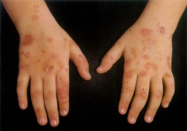METABOLIC DISEASE, NUTRITION - Porphyria cutanea tarda METABOLIC DISEASE, NUTRITION - Porphyria cutanea tarda
