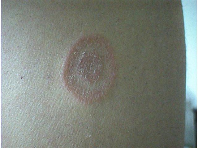 SUPERFICIAL FUNGAL INFECTIONS - Tinea corporis due to trichophyton SUPERFICIAL FUNGAL INFECTIONS - Tinea corporis due to trichophyton