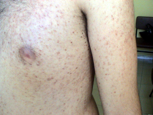 MASTOCYTOSES - Urticaria Pigmentosa