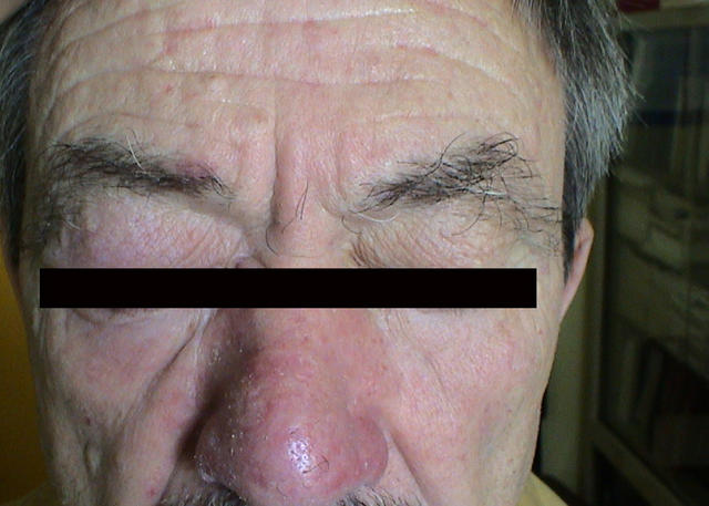 DISEASES OF THE SEBACEOUS GLANDS - Rosacea