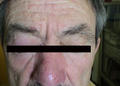 DISEASES OF THE SEBACEOUS GLANDS - Rosacea