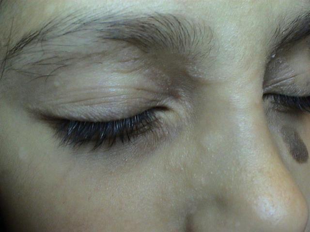 DERMATITIS - EKZEMA - Dermatitis of the eyelids DERMATITIS - EKZEMA - Dermatitis of the eyelids