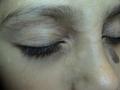 DERMATITIS - EKZEMA - Dermatitis of the eyelids