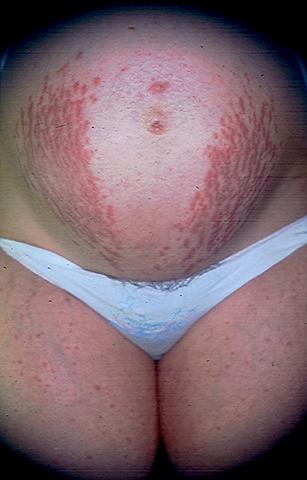 SKIN DISEASES IN PREGNANCY - Polymorphic Eruption of Pregnancy (Pruritic Urticarial Papules SKIN DISEASES IN PREGNANCY - Polymorphic Eruption of Pregnancy (Pruritic Urticarial Papules