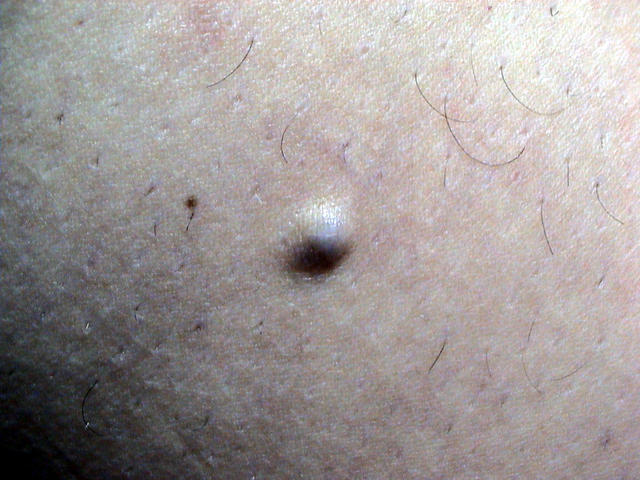 BENIGN SKIN LESIONS, NEVI, CYSTS - Blue Naevus BENIGN SKIN LESIONS, NEVI, CYSTS - Blue Naevus