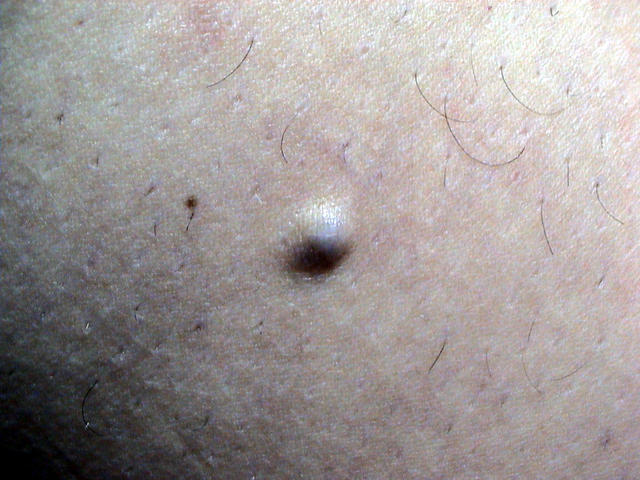 BENIGN SKIN LESIONS, NEVI, CYSTS - Blue Naevus