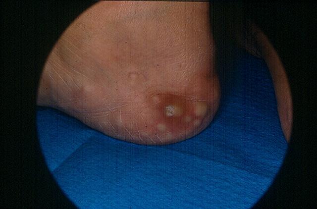 VARIOUS or of UNKNOWN ETIOLOGY DISEASES - Piezogenic Papules VARIOUS or of UNKNOWN ETIOLOGY DISEASES - Piezogenic Papules