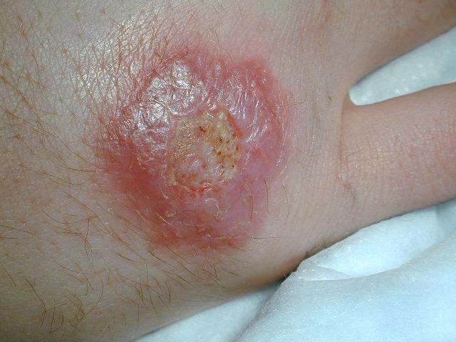 PARASITOSES, BITES - Cutaneous leishmaniasis