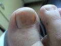 PSORIASIS - Psoriatic nails